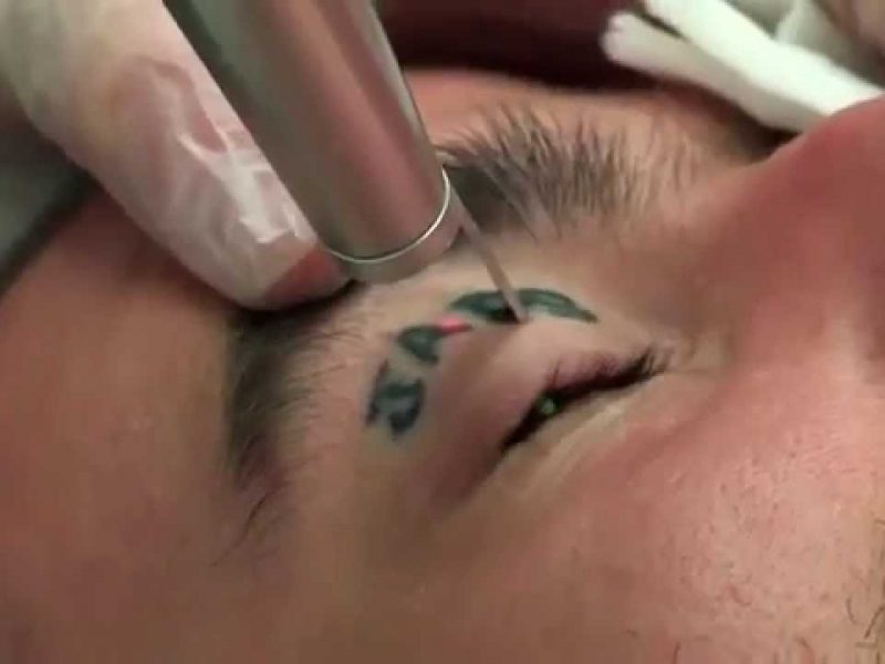 ‘All about Laser treatment for tattoo removal