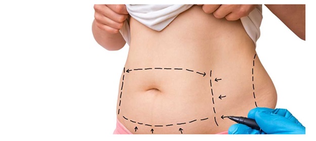 2 Best Surgery Options For Fat Removing