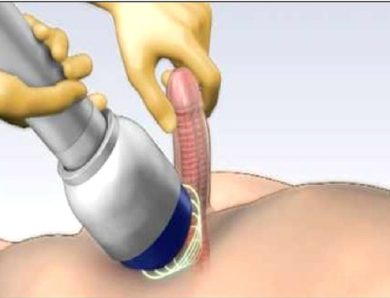 Why Men Are Choosing Shockwave Therapy for ED Over Pills