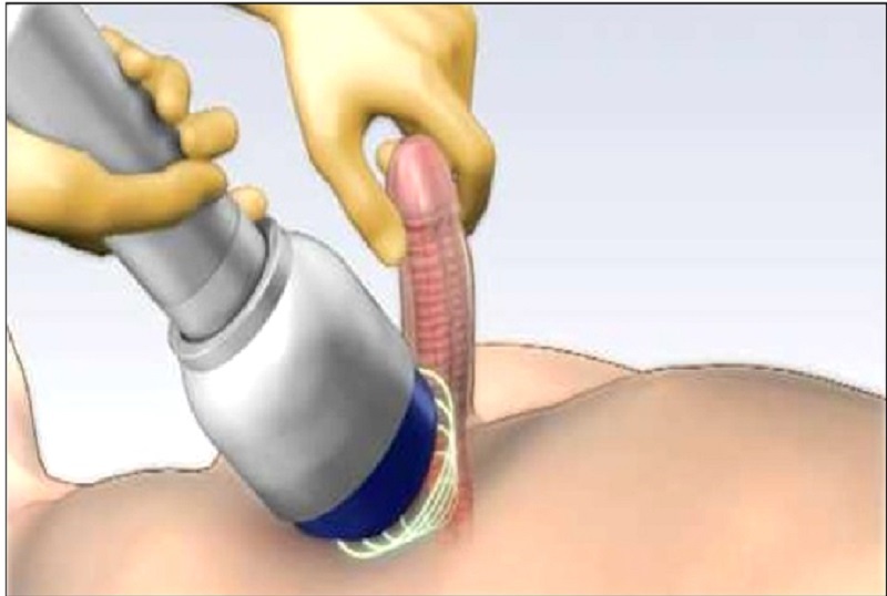 Why Men Are Choosing Shockwave Therapy for ED Over Pills