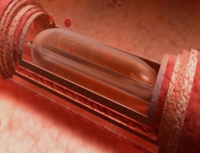 How Cardiologists Use Balloon Angioplasty to Restore Healthy Circulation