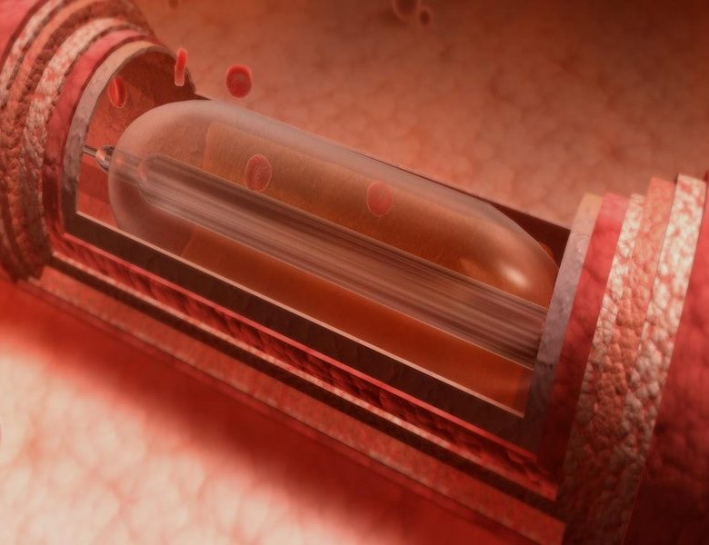 How Cardiologists Use Balloon Angioplasty to Restore Healthy Circulation